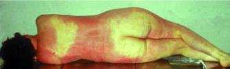 Typical red discoloration in victim of fatal CO poisoning