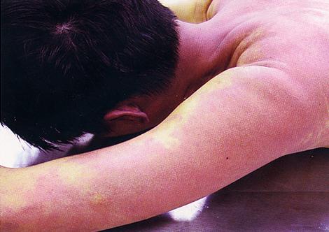 fatal case of CO poisoning displaying pink discoloration