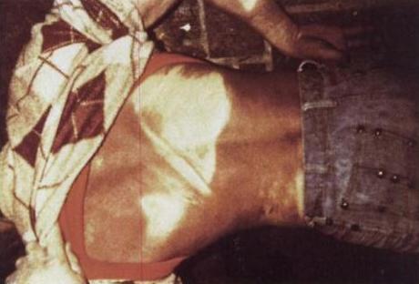 Crime scene photo deep purplish discoloration